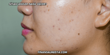 Siyah Lekeler Nasıl Geçer?