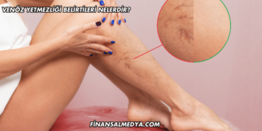 Venöz Yetmezliği Belirtileri Nelerdir?